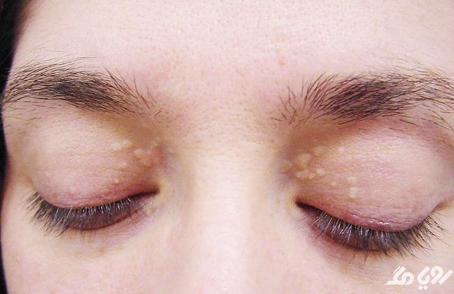 علت لکه های زرد روی پلک چشم