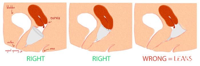 قرارگیری کاپ قاعدگی در واژن