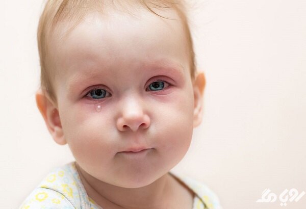 عفونت چشم بچه و درمان آن